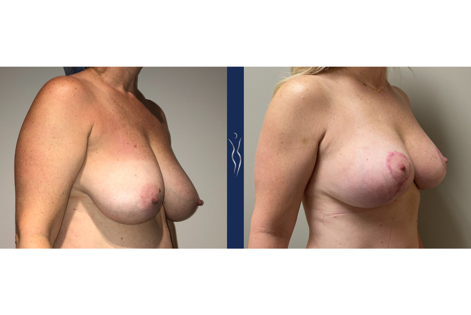 46 year old lady breast augmentation with lift right oblique 3 months