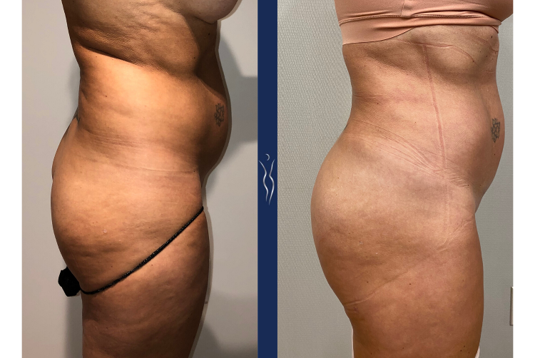 53 year old caucasian woman Brazilian Buttock Lift right lateral-1