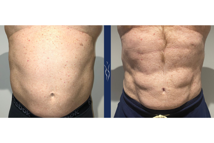 61 year old caucasian male high definition liposuction with Renuvion front arms out-1