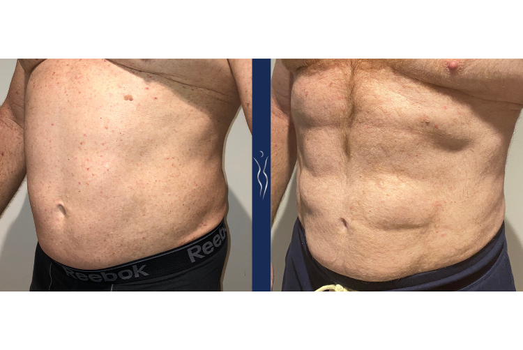 61 year old caucasian male high definition liposuction with Renuvion left oblique-1
