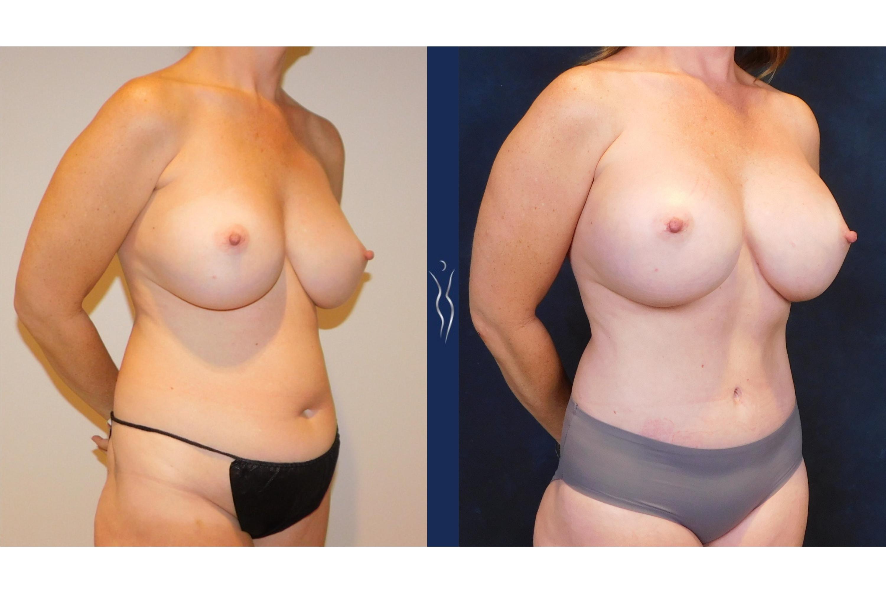 4-43 year old lady Mommy Makeover 6 month right oblique