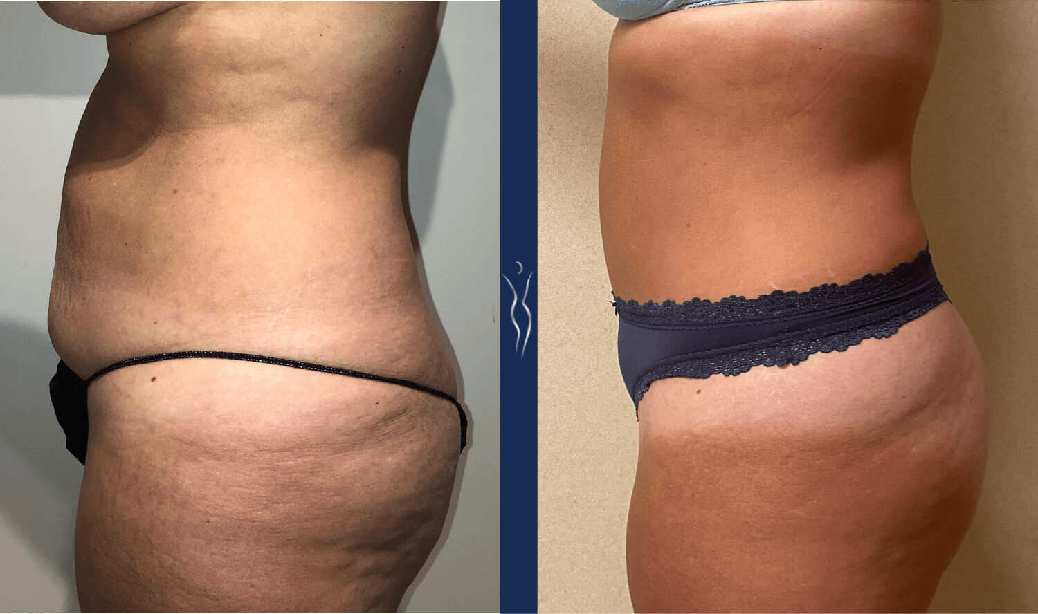 41 year old caucasian woman tummy tuck left lateral