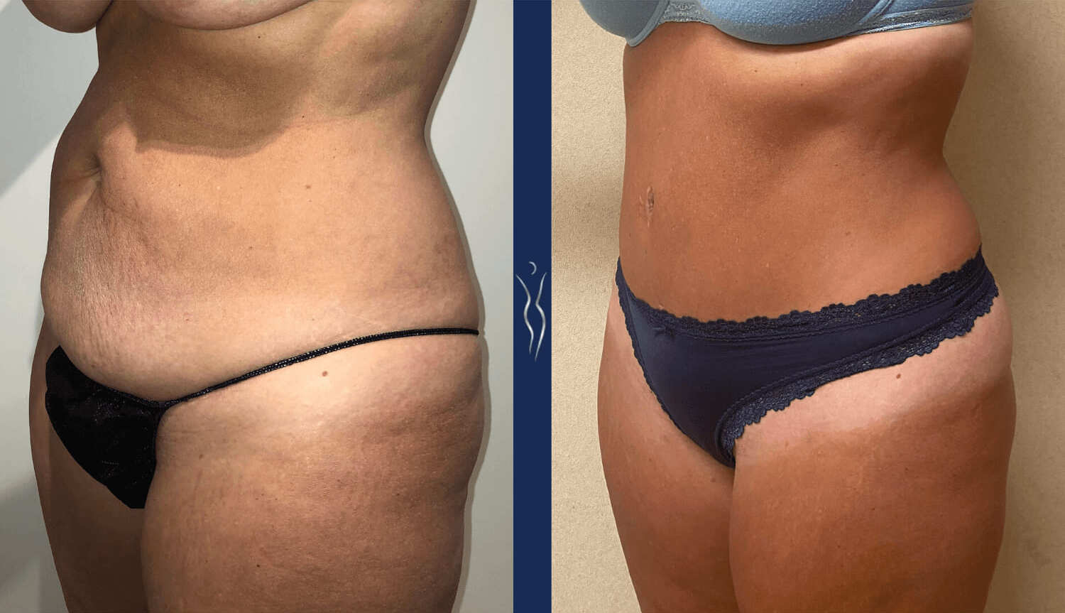 41 year old caucasian woman tummy tuck left oblique