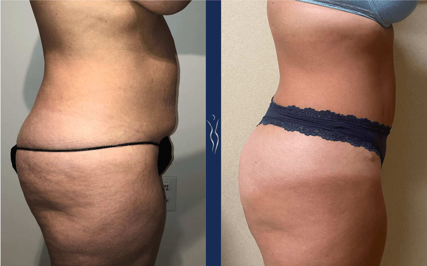 41 year old caucasian woman tummy tuck right lateral