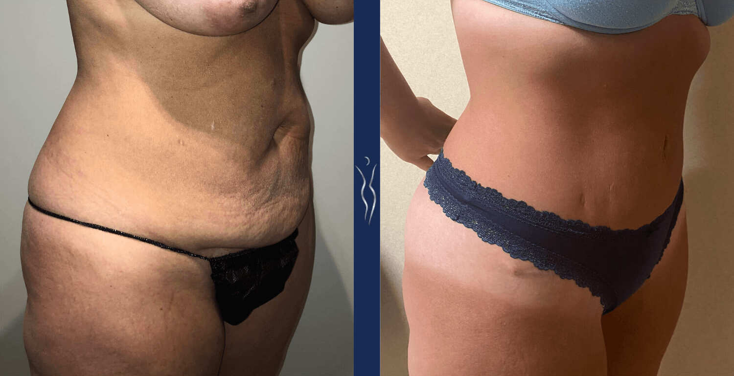 41 year old caucasian woman tummy tuck right oblique