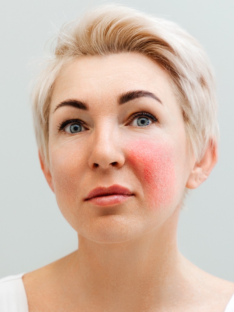 vascular - services page - rosacea