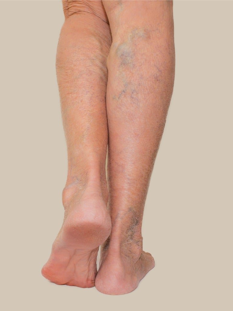 Varicose Vein Treatment in Nashville