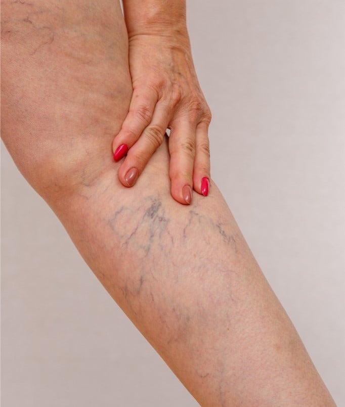 Spider Vein Treatment in Nashville