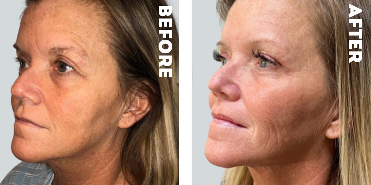 Facial Cosmetic Before and After Photos in Nashville