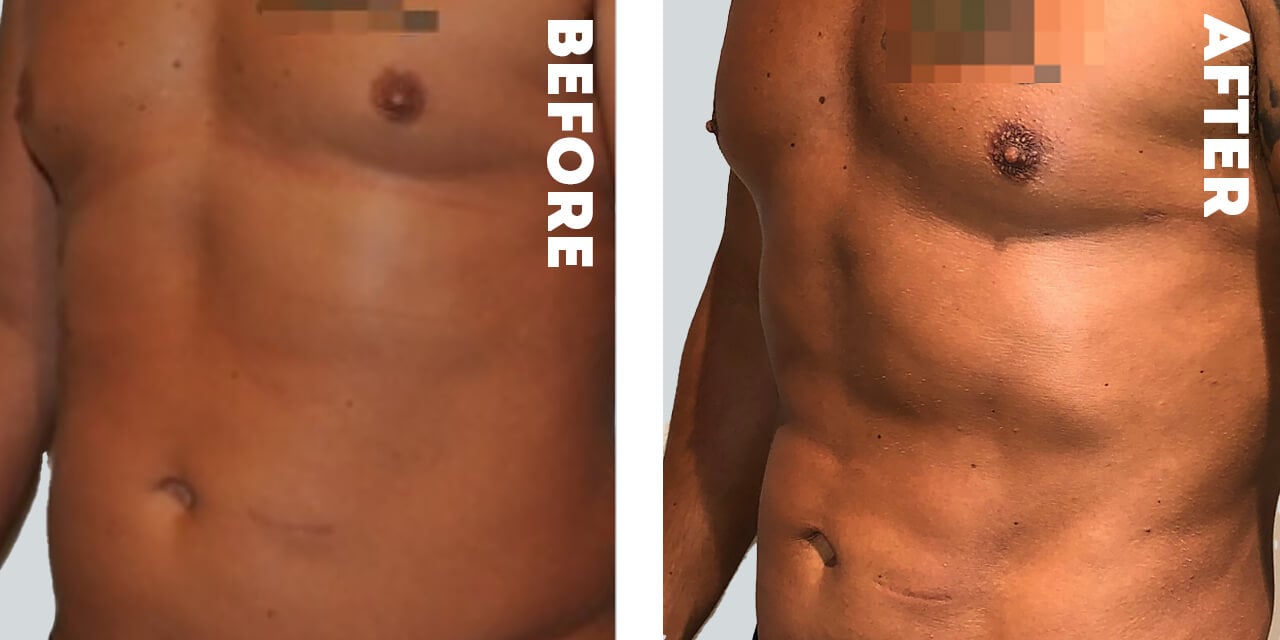 Male Body Contouring Before and After Photos in Nashville