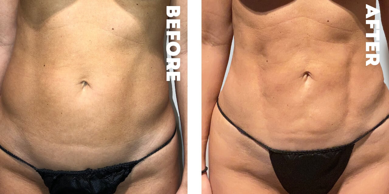 Female Before and After Body Contouring Photos in Nashville