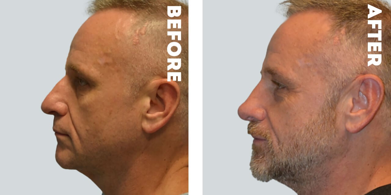 Male Facial Rejuvenation Before and After Photos in Nashville