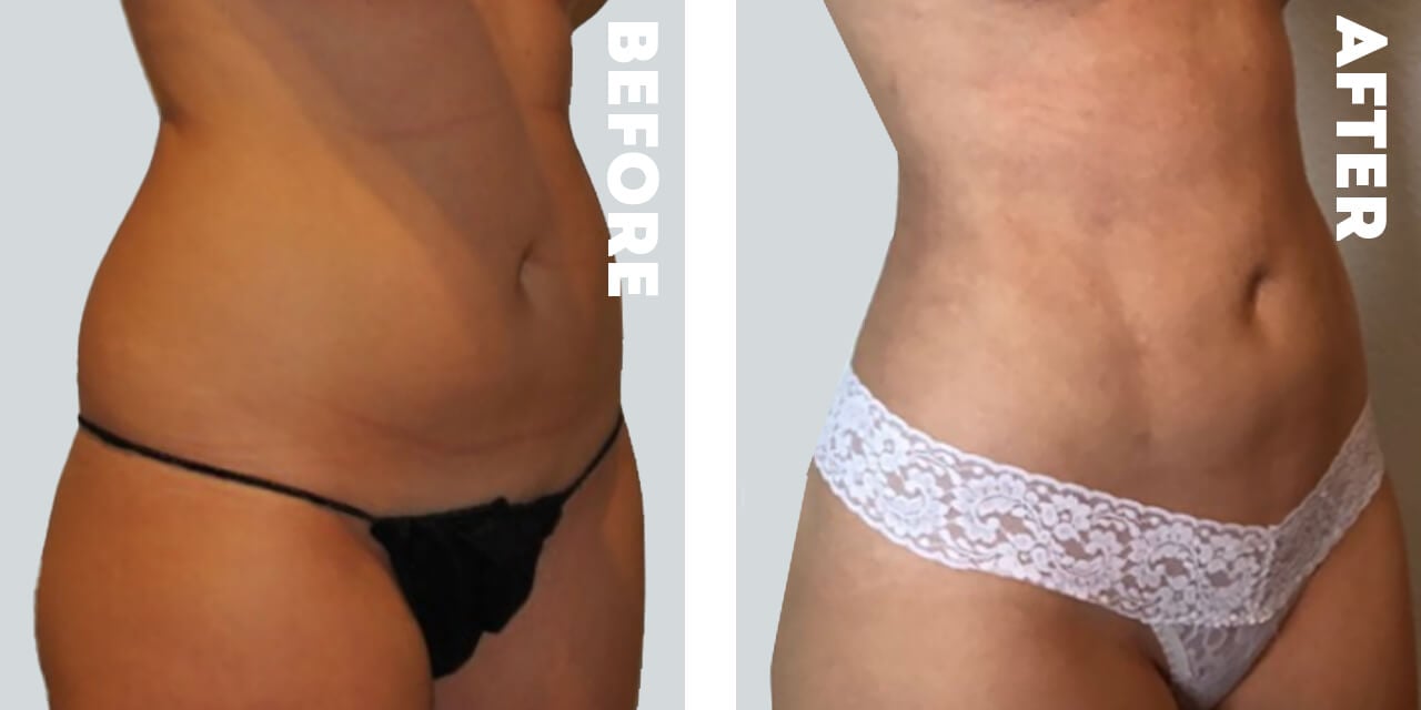 Body Contouring Patient Photos in Nashville