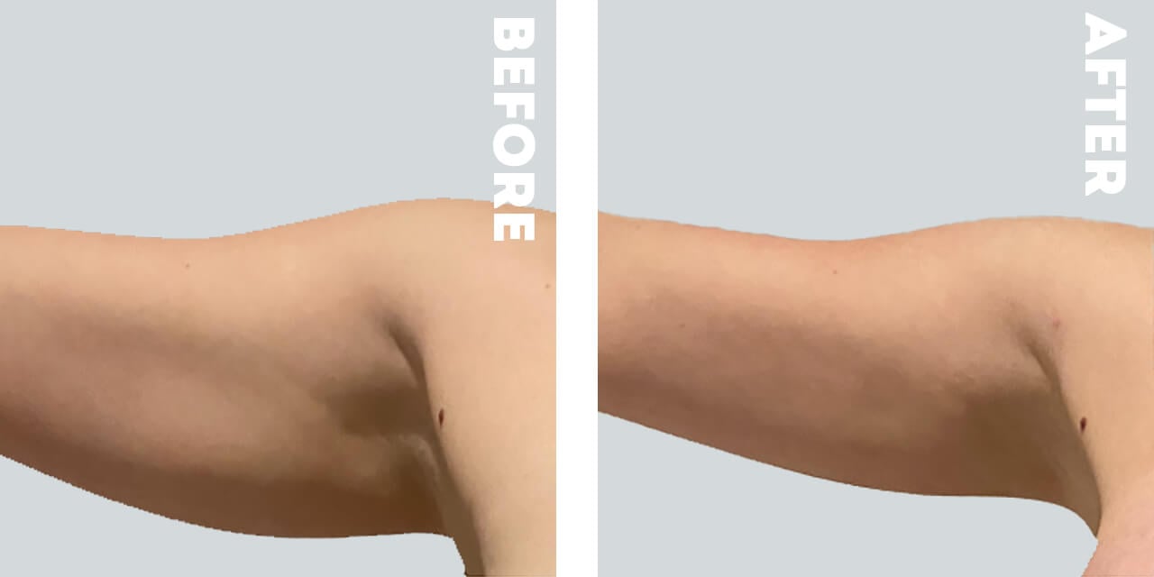 Arm Lift Before and After Photos in Nashville