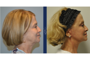69 year old caucasian woman face and neck lift with upper eye lid lift, fat transfer to the face, and erbium skin resurfacing right lateral