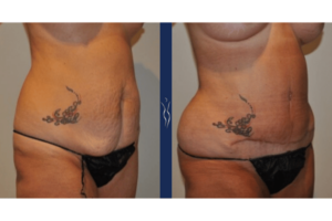55 year old caucasian woman tummy tuck with core liposuction right oblique arms back﹖width=630&name=55 year old caucasian woman tummy tuck with core liposuction right oblique arms back