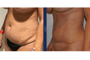 53 year old caucasian lady 4 months tummy tuck left oblique arms forward﹖width=541&name=53 year old caucasian lady 4 months tummy tuck left oblique arms forward