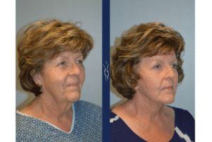 57 year old caucasian woman face and neck lift with upper eye lid lift right oblique﹖width=1890&name=57 year old caucasian woman face and neck lift with upper eye lid lift right oblique