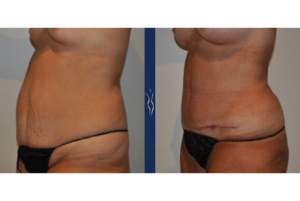 55 year old caucasian woman tummy tuck with core liposuction left oblique arms forward﹖width=1800&name=55 year old caucasian woman tummy tuck with core liposuction left oblique arms forward