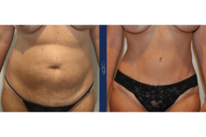 38 year old caucasian lady 4 months tummy tuck front arms down 1﹖width=315&name=38 year old caucasian lady 4 months tummy tuck front arms down 1