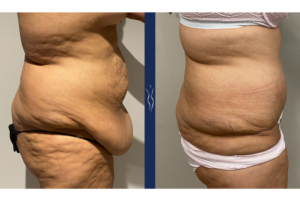 31 year old lady fleur di lis tummy tuck 4 months right lateral (1) 1