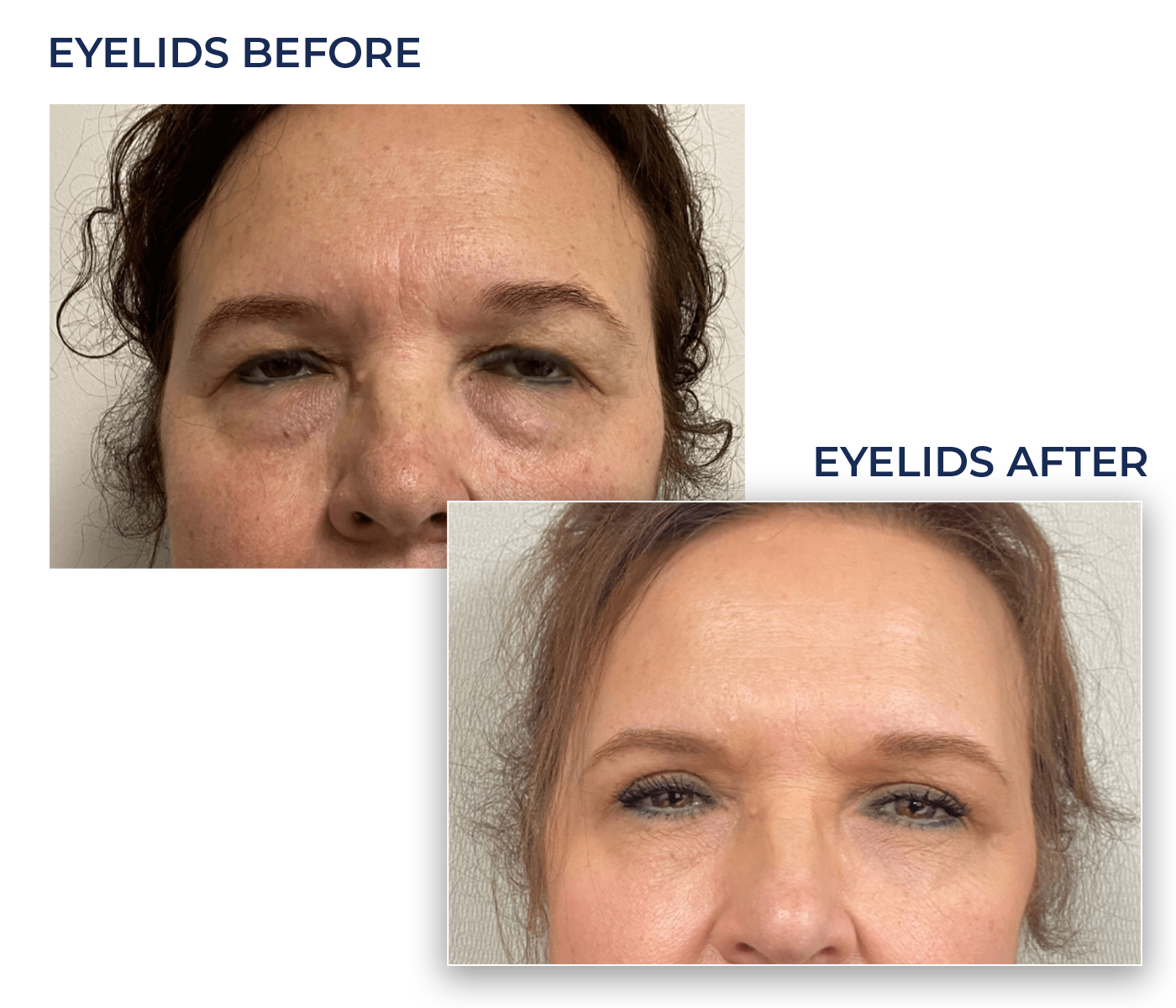 eyelid eyelid