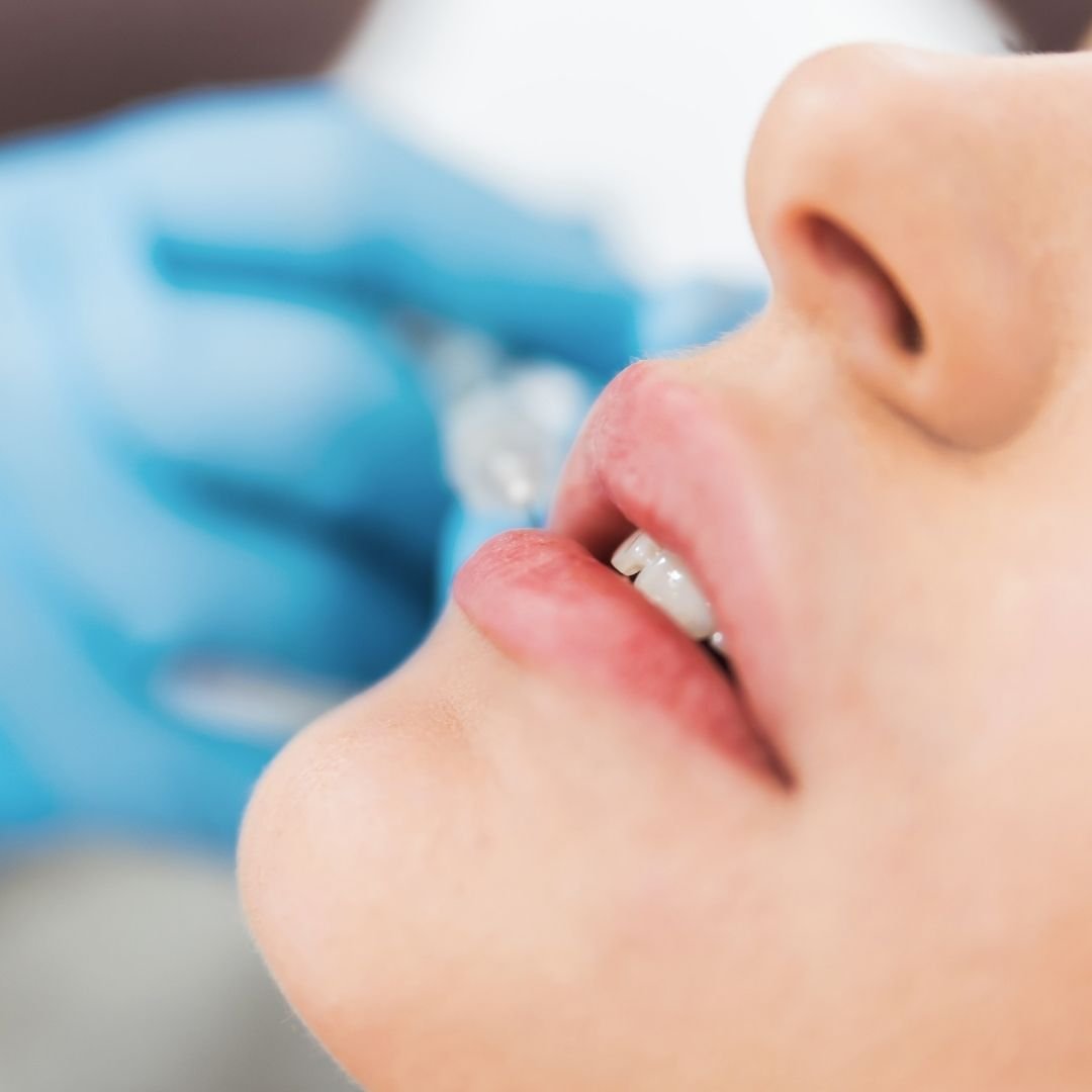 lip filler august special
