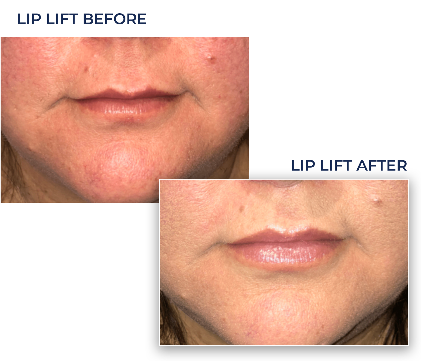 lip lift B&A