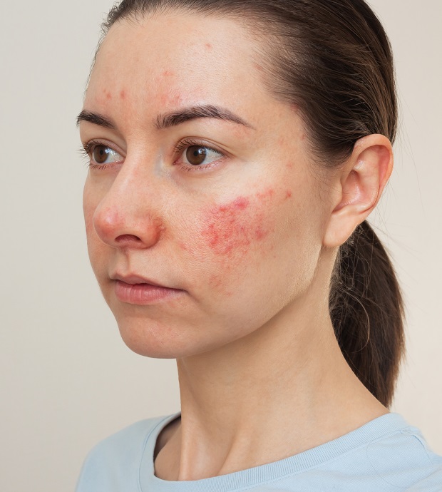 Rosacea Treatment Nashville