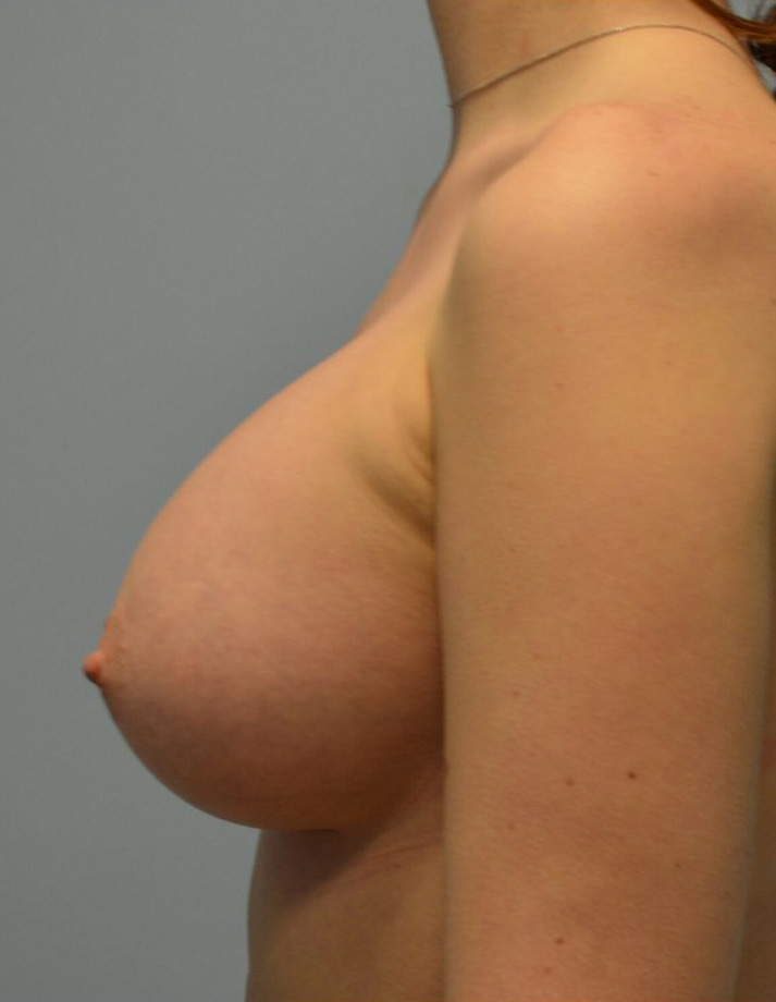 After Image: Breast Augmentation - 