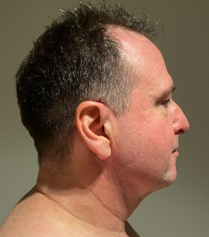 After Image: Neck Liposuction with Skin Tightening (Renuvion) - right-side