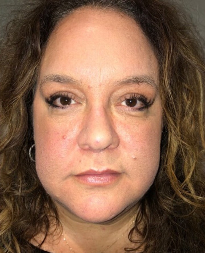 After Image: Blepharoplasty - front