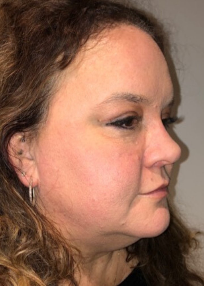 After Image: Blepharoplasty - right-front-oblique