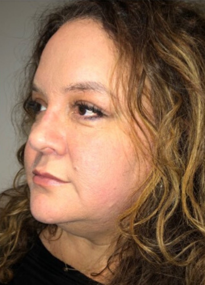 After Image: Blepharoplasty - left-front-oblique