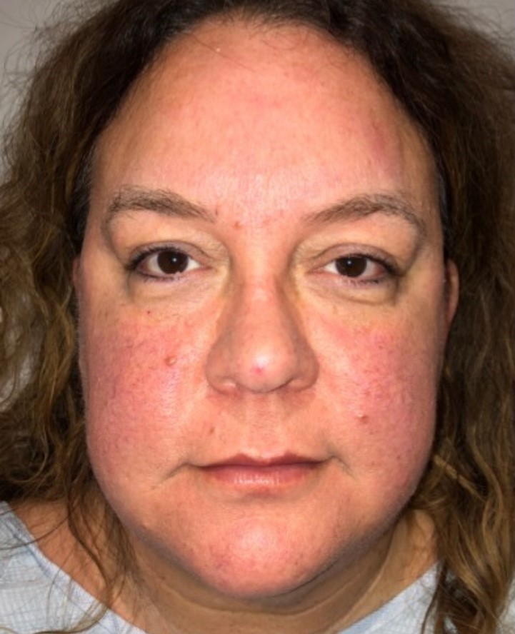 Before Image: Blepharoplasty - front