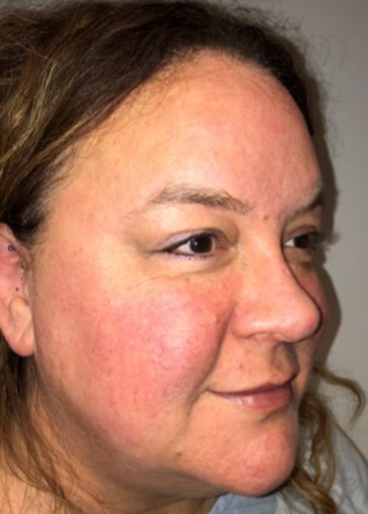 Before Image: Blepharoplasty - right-front-oblique