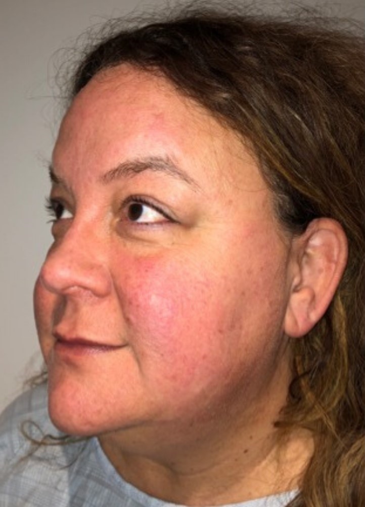 Before Image: Blepharoplasty - left-front-oblique