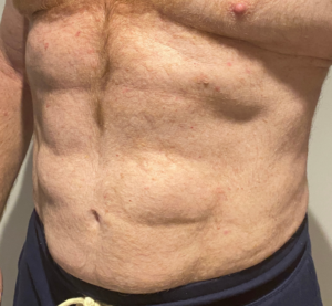 After Image: High Definition Liposuction