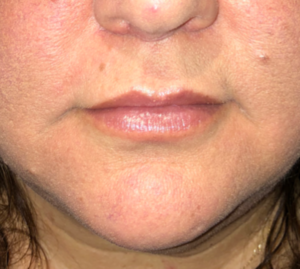 After Image: Surgical Lip Lift