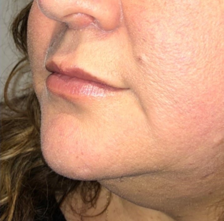 After Image: Surgical Lip Lift - left-front-oblique