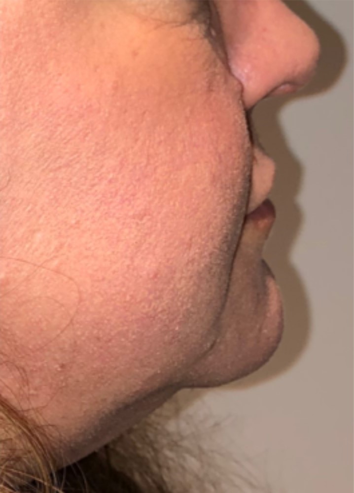 After Image: Surgical Lip Lift - right-side
