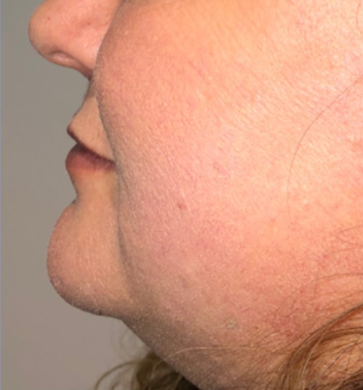 After Image: Surgical Lip Lift - left-side