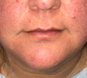 Before Image: Surgical Lip Lift