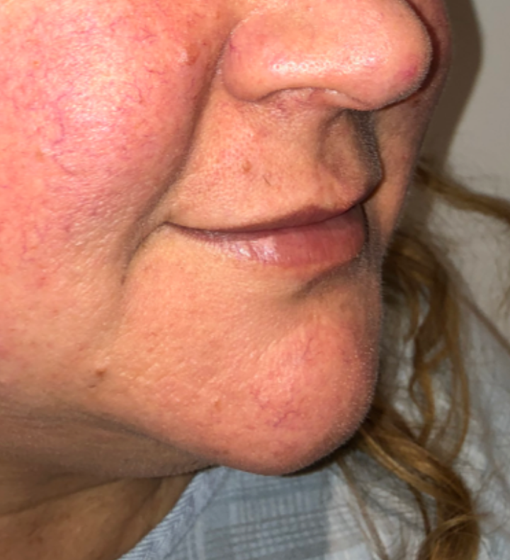 Before Image: Surgical Lip Lift - right-front-oblique