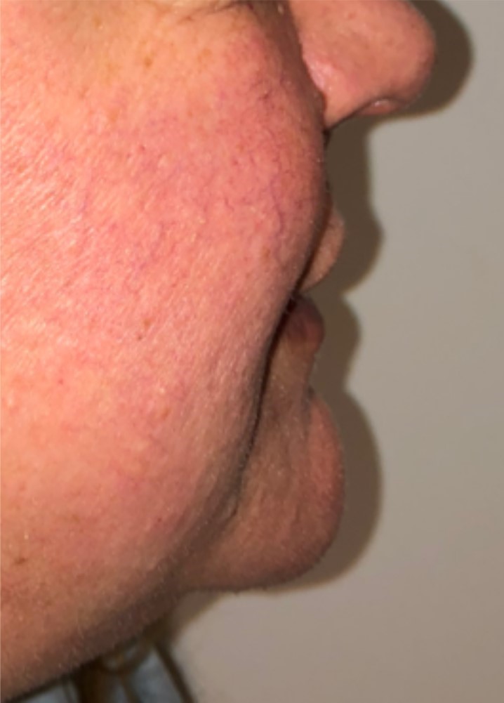 Before Image: Surgical Lip Lift - right-side