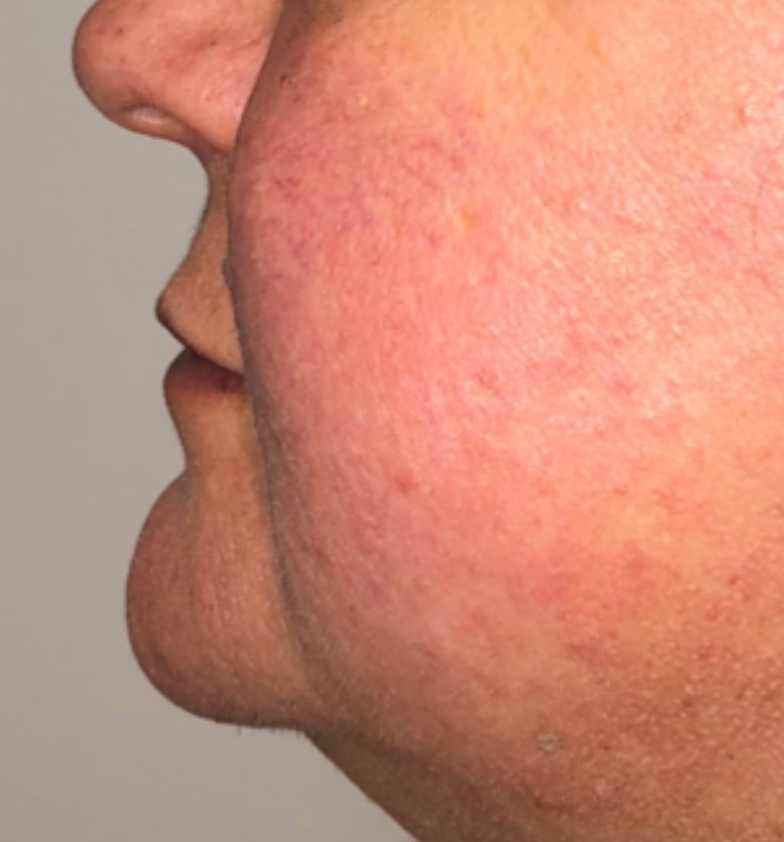 Before Image: Surgical Lip Lift - left-side