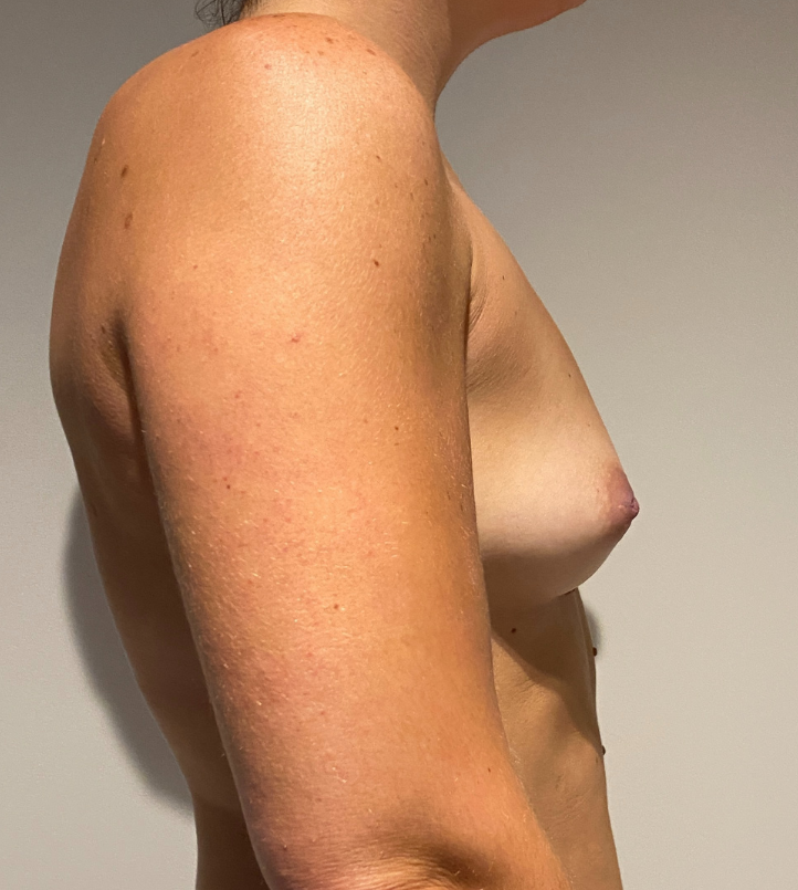 Before Image: Breast Augmentation - right-side