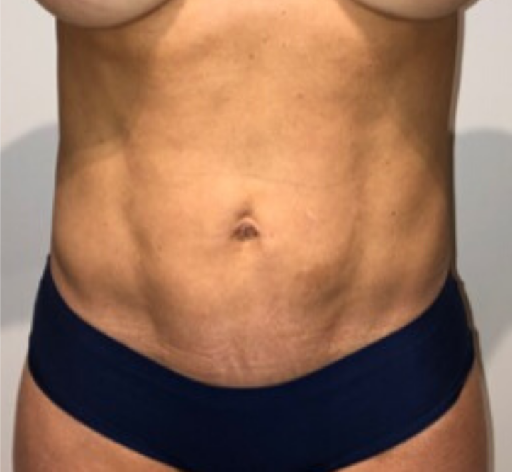 After Image: High Definition Liposuction - front