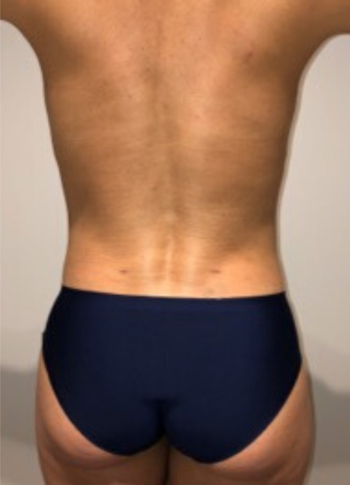 After Image: High Definition Liposuction - back