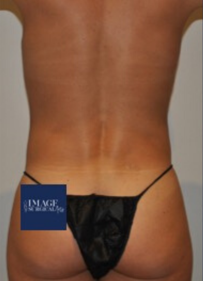 Before Image: High Definition Liposuction - back